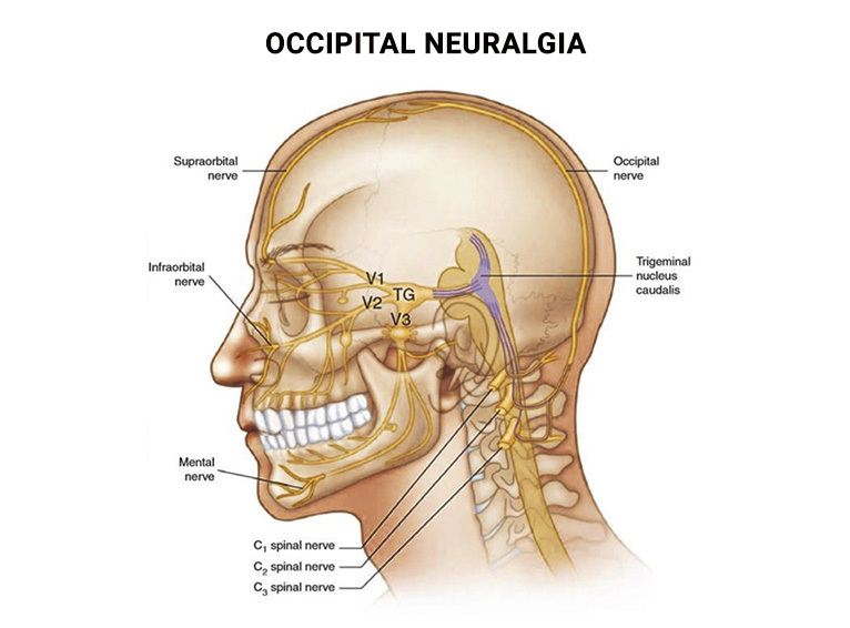 Occipital Neuralgia