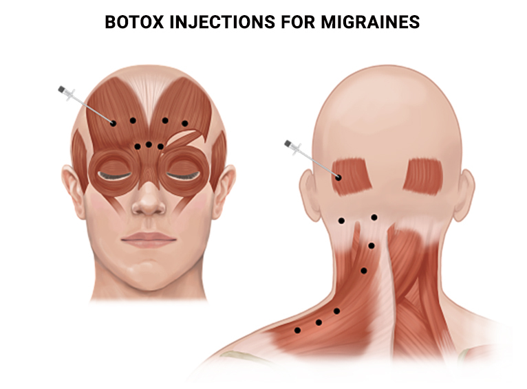 Botox Injections for Migraines