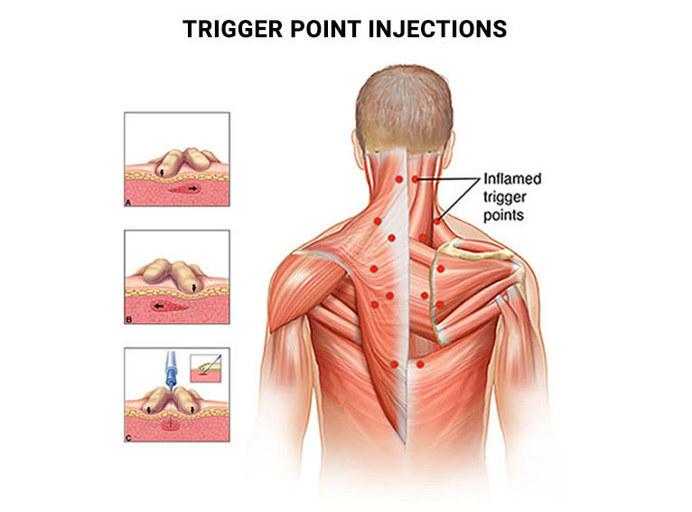 Trigger Point Injections